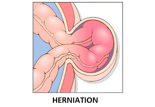 Strangulated hernia progression diagram